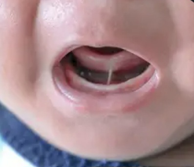 Tongue Tie: What Every New Parent Should Know